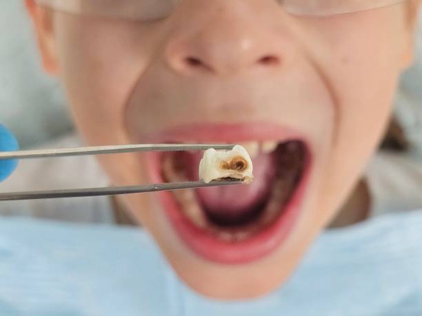 Best Emergency Dental Extractions in Mentor, OH
